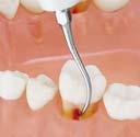 REF: Z291425 anwendbar bei ein- und mehrwurzeligen Zähnen MODELL: P26R REF: Z217426 P26R Rechtsgebogen