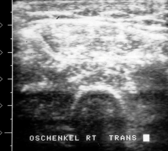 15 a b b A B Abbildung 3 : Sonographische, transversale Darstellung der Oberschenkelmuskulatur (A) eines 4 Jahre alten Kindes mit Becker-Kiener Muskeldystrophie (erhöhte Echogenität des
