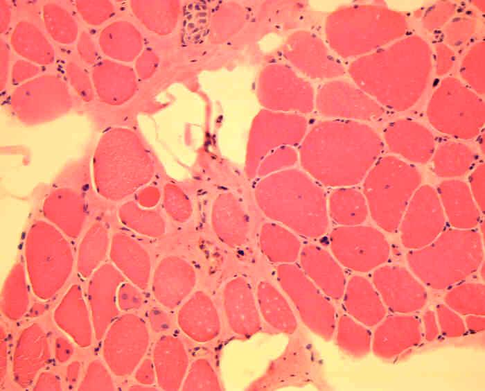 17 Neuropathiezeichen gruppierte Atrophien Fasertypengruppierung Kernklumpen schmale anguläre Fasern Zeichen einer Inflammation Makrophagen T-Zellen Monozyten c a a b Abbildung 4 :