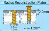 2.7 Titanium Radius Reconstruction Plates Titan Radiusrekonstruktionsplatten Profile height 2.2 mm, Order quantity: Package of 1. Profilhöhe 2,2 mm, Bestelleinheit: Packung zu 1 Stück.