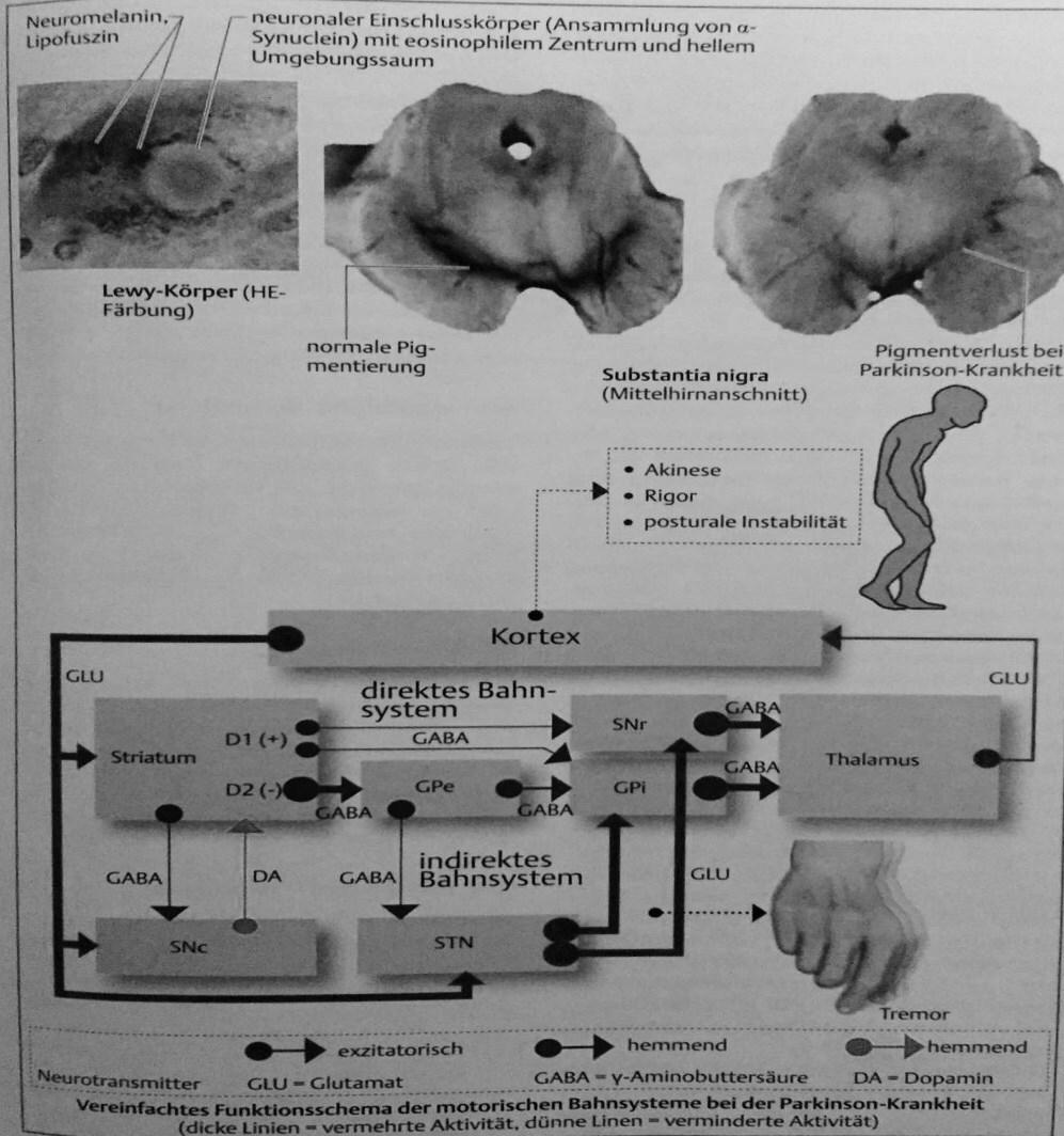 Abbildung 1: Vereinfachtes Funktionsschema der motorischen Bahnsystheme bei der Parkinson-Krankheit (Rohkamm 2009, S.