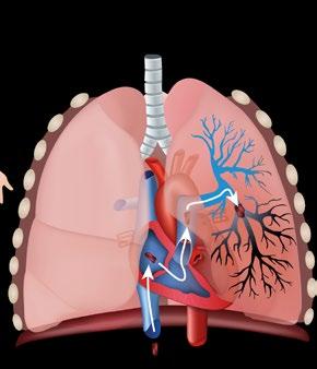 Dadurch wird Lungenembolie (Lungenthrombembolie) die Atemfunktion beeinträchtigt.