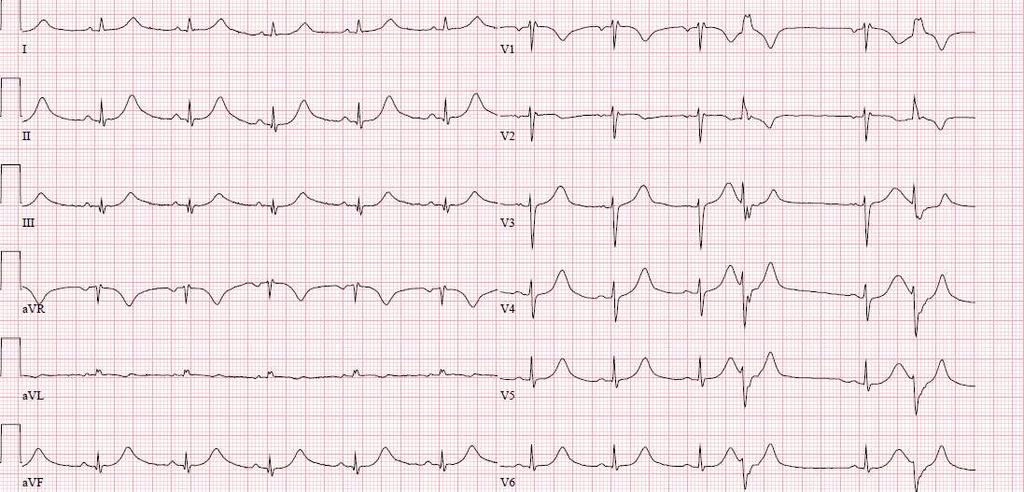12-Kanal-EKG: Verdachtsdiagnose?
