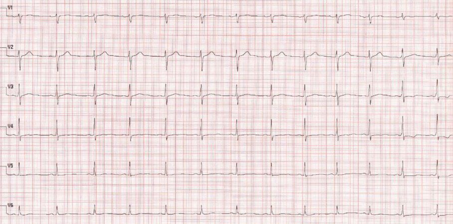 Was ist Ihre Diagnose? 357 sen sich im EKG zwar nicht abgrenzen, dies kann aber mitunter schwierig bzw. unmöglich sein. Zur genauen Diagnosestellung sind somit weitere Informationen notwendig.