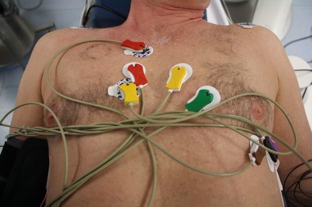 Abbildung 2: Anordnung der Elektroden des Lewis-Lead-EKGs. Veröffentlichung des Bildmaterials mit Einverständnis der abgebildeten Person. 3.5.