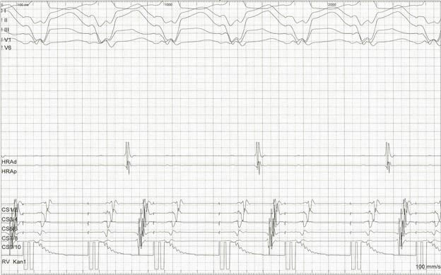 Abbildung 5: Intrakardiales EKG mit einem ventrikuloatrialen Überleitungsverhältnis von 2:1. HRA, high right atrium; CS, coronary sinus; RV, right ventricle.