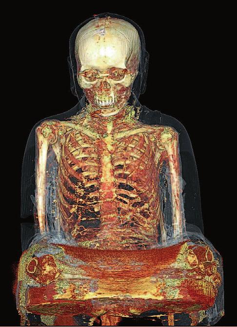 338 ERIK BRUIJN, AMELIE ALTERAUGE U.A. Abb. 2 (links) Visualisierung des Skeletts der Mumie in der Buddha- Statue. Abb. 3 (rechts) Das Röntgenbild zeigt Intarsien in den Augenhöhlen sowie eine Metallstrebe zwischen Mumie und Übermodellierung.