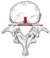 flavum d) Processus articularis suerior vertebrae e) Lamina arcus vertebrae