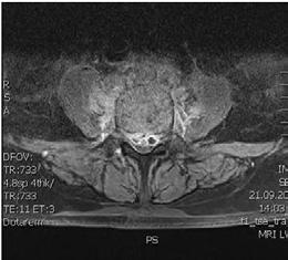aureus Sepsis mit: Paravertebralem Abszess Gonarthritis rechts Spondylodiscitis L4/L5 Verdacht auf Mitralklappenendokarditis Wie erhärte ich die Diagnose der Endokarditis?