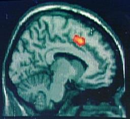 Patientenedukation der rote Faden Schmerzerleben im Gehirn - ACC nach Spitzer 2005 ACC anteriorer Cyrus Cinguli wie weh tut es?