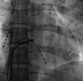 9 Elektrophysiologische Untersuchung 9.5 Intrakardiales EKG 9.5 Intrakardiales EKG Die intrakardialen Elektrogramme werden bei Sinusrhythmus bzw. dem vorliegenden Grundrhythmus registriert.