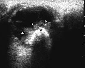 Abb. 8: Retinoblastom, 2 Jahre altes Mädchen. Linker Bulbus axial. Große gelappte Raumforderung (>) mit ausgedehnter Verkalkung (*) mit Schallschatten. Abb.