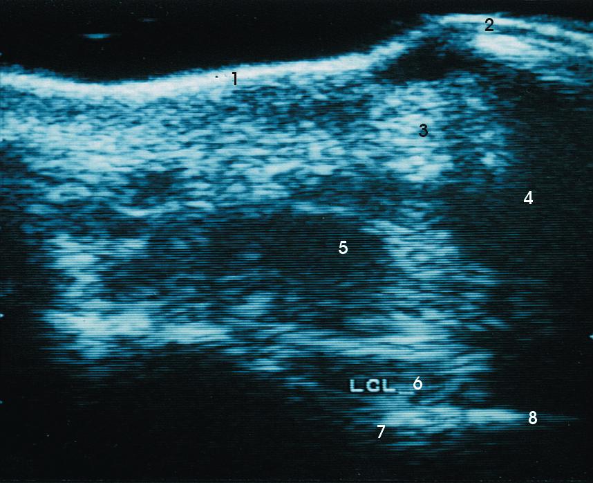 Abb. 20: Hufgelenk, frontal, in kollateraler Projektion (Facies longitudinalis dorsolateralis) 1 - Haut 5 - Lig.