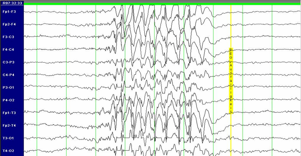 Einleitung Abb.4: Interiktales EEG eines 20-jährigen Mädchens mit Juveniler Absence Epilepsie. Im EEG bilateral synchrone spike-wave Komplexe.