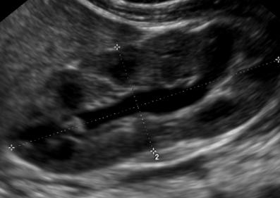 Meist wird diese Veränderung, so wie man sie per Ultraschall sehen kann, nach Graden, definiert von der Society for fetal Ultrasound (SFU) eingeteilt: Grad 1: Nur das Nierenbecken (NB) ist
