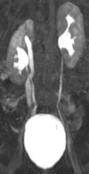 Niere elch Nierenbecken elch Magnetresonanz-Urografie des Harntraktes. Links (im Bild rechts) hat das ind eine normale Niere mit einem Harnleiter, der zur Blase führt (s. Beschriftung).