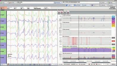 Online-EEG-Analysen Parallel zum EEG erfolgt die Darstellung der Online-EEG Mustererkennung nach ACNS* Standard durch NeuroTrend, inkl.