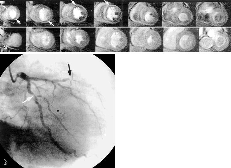 Kardiale Magnetresonanztomographie aktueller Stellenwert in der Diagnostik der koronaren Herzerkrankung V/53 (Sensitivität: 86 vs. 74%; Spezifität: 86 vs.