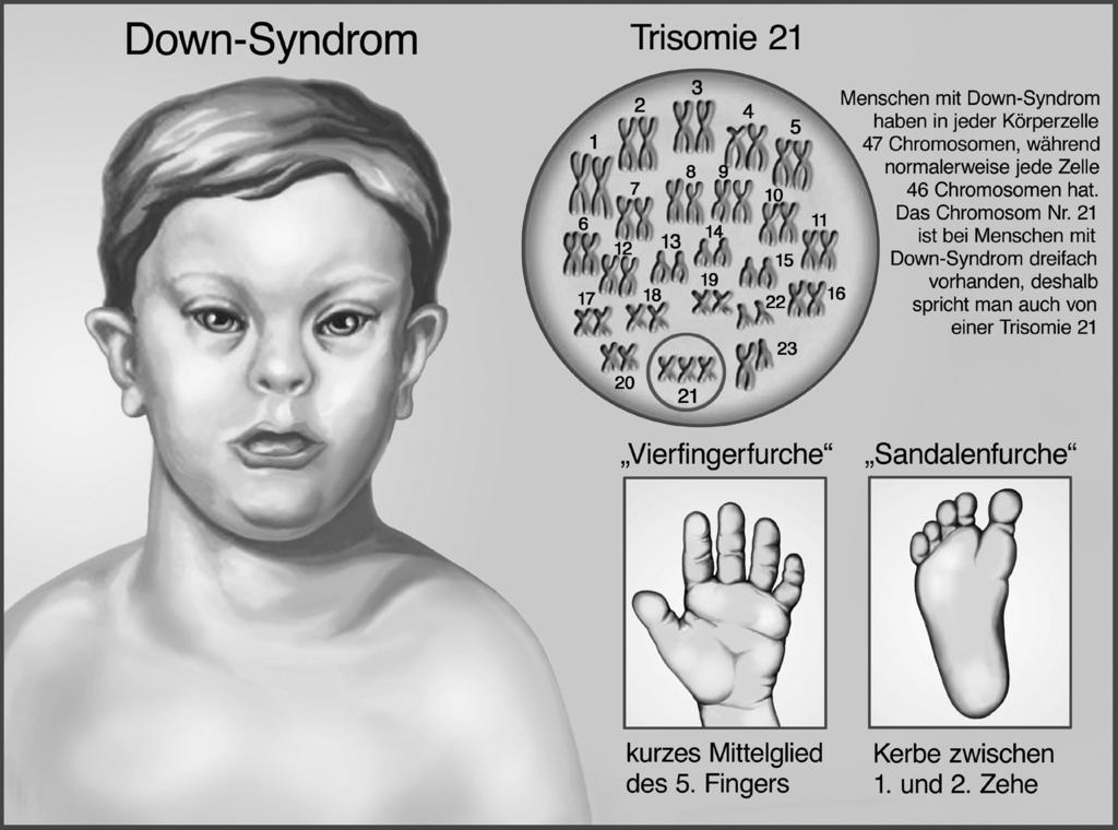 RAAbits Hauptschule 7 9 Naturwissenschaften 68 Erbkrankheiten 3 von 10 M 1 Das Down-Syndrom oder Trisomie 21 Aufgabe 1 Betrachte die Zeichnungen und lies die Texte.