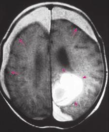 Zerebrale Kontusionsblutungen werden am häufigsten im Bereich der Frontal- und der Temporallappen beobachtet.