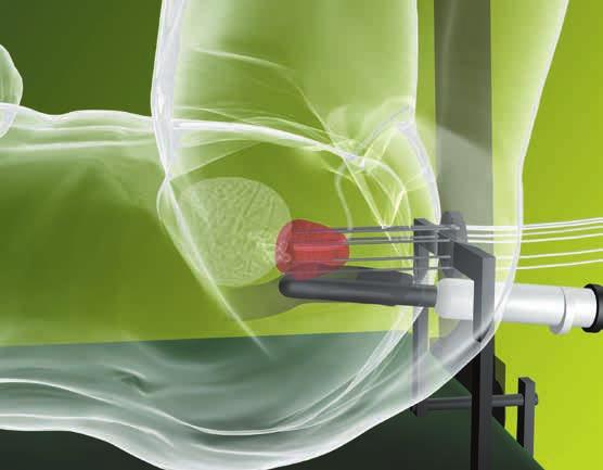 Abbildung 12 Aus dem High-dose-rate -Brachytherapiegerät fährt die Strahlungsquelle in vorgegebener Zeit in die einzelnen Schläuche; bis zu 17 Schläuche