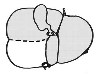 1 Einleitung - 11 - anatomische Hemihepatektomie rechts anatomische Hemihepatektomie links Trisegmentektomie