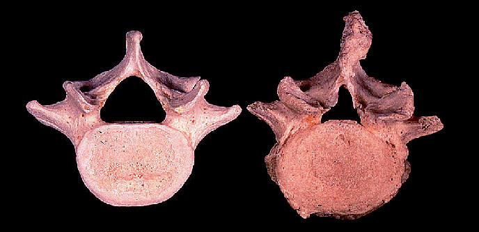 304 A. Mehrkens, B. Jeanneret: Claudicatio spinalis Abb. 1 Links im Bild ist der Wirbelkörper L5 einer jungen Person abgebildet, rechts einer alten Person.