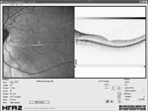 Spectralis HRA + OCT Difference in thickness (scan set 1 scan set 2) (µm) Central