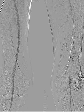 Mitte links: Sondieren des Gefäßstumpfes mit einem Terumo-Draht und einen gebogenen diagnostischen Katheter, wobei der Draht in Form einer Schlinge bis zur Arteria poplitea