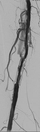 2007 eine perkutane transluminale Angioplastie mit oder ohne Stenting im Bereich der A.