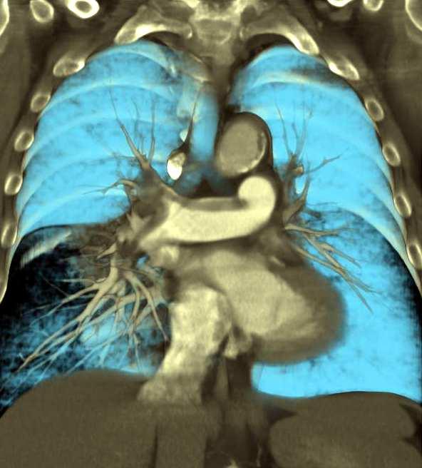 Pulmonalis-CT CT vs.