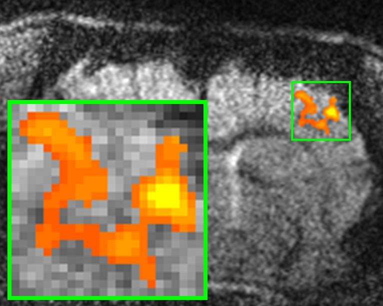 10.6. Anstieg des BOLD-Kontrastes mit höherer Auflösung Abbildung 10.30.: Struktur S1FL-Aktivierung mit 193 Pixel bei einer Auflösung von 75 µm. 193 Pixel entsprechen 1.