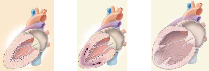 Normal heart Myocardial infarction Heart failure?