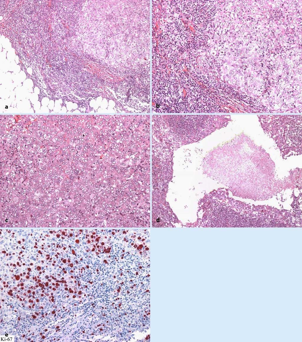Abb. 1 8 Typisches medulläres Mammakarzinom. a Histologisch eher verdrängend als infiltrierend vorwachsende Tumorperipherie.