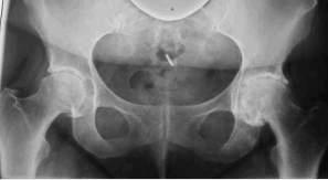 Röntgenuntersuchung Kniegelenk a.p. im Stehen und seitlich (ggf.