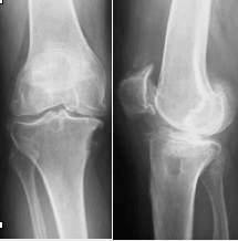 Mediale Kniearthrose Kontraindikation zur medialen unicondylären Schlittenprothese Beidseitige Knorpel- und