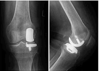 Laterale Kniearthrose Indikation zur lateralen unicondylären Schlittenprothese Kein wesentliches Übergewicht Bandstabilität, insbesondere vorderes und hinteres Kreuzband Keine Beinachsenabweichung
