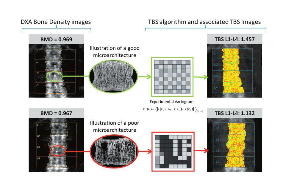 2 TBS insight TM ein neues Hilfsmittel zur Identifizierung von Patienten mit erhöhtem Frakturrisiko TBS insight TM ist ein Softwareprogramm, welches auf vorhandene DXA-Scanner installiert werden kann.