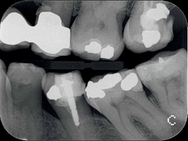 Herausragende Bildqualität in Sekunden Mit einer tatsächlichen Auflösung von bis zu 17 LP/mm liefert das CS 7600 die für eine sichere Diagnose erforderliche hohe Bildqualität.