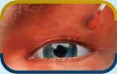 10 % Povidon-Iod-Lösung) auf die periokulare Haut, die Augenlider und Wimpern auftragen, ohne zu starken Druck auf die Augenliddrüsen