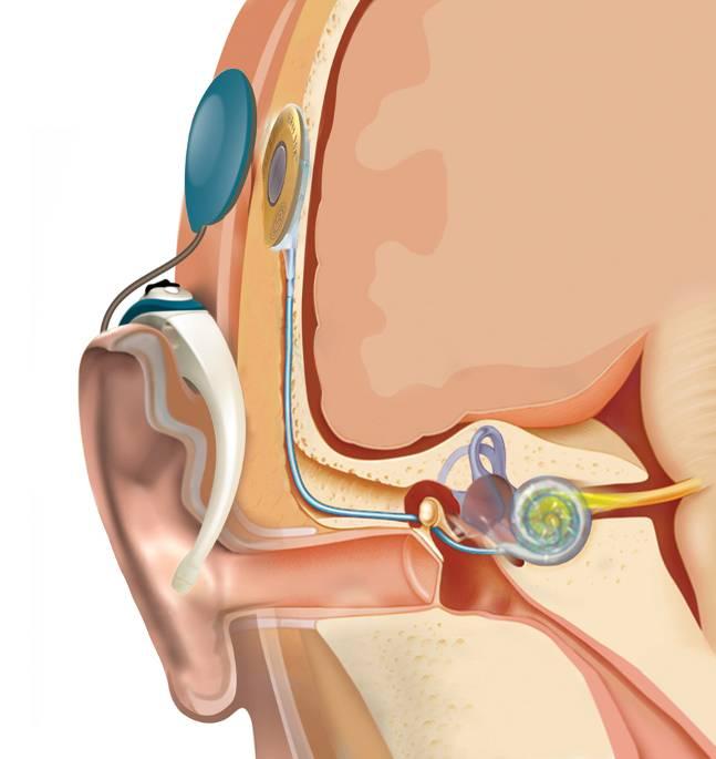 Cochlea Implantat (CI) Implantiertes