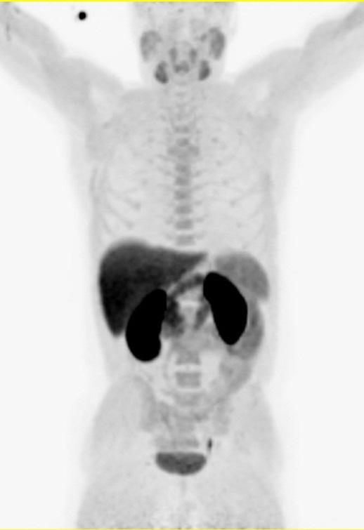 18F-Fluor-Cholin Cholin-PET/CT: Prostatakarzinom #1 Ind.