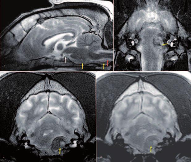 6.2 Schädel-Hirn-Trauma 147 MRT-Befunde Charakteristisch für das epidurale Hämatom ist eine den Calvarien anliegende, gegen das Gehirnparenchym konvexe oder bikonvexe Raumforderung mit Verlagerung
