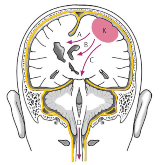 Hirnmassenverschiebung und Herniation Das Gehirn verfügt bei intrakranieller Drucksteigerung über Kompensationsmechanismen.
