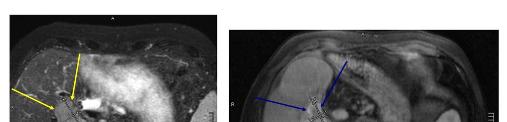 Fallbeispiel: Intrahepatisches Cholangiozelluläres Karzinom Gallengangskarzinom, links vor, rechts nach Protonenbestrahlung im RPTC bei Zustand nach vorlaufender
