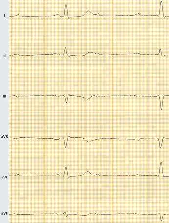 5 (die QRS-Komplexe zeigen keine Assoziation mit der p-welle). Die Bradykardie ist umso ausgeprägter, je AV- Knoten-ferner (infrahissär) der ventrikuläre Ersatzrhythmus entsteht.