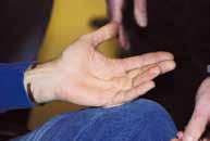 6 Injektion mit Kollagenase Neben der Operation gibt es nun eine neue Behandlungsmethode, die es dem Patienten möglich macht, Einziehungen der Finger zu beheben.