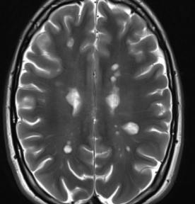 Neurology 2015;85:722-729 Daclizumab: Anti-CD25- Antikörper Phase-III DECIDE : Schubrate >1800 Patienten, 1:1, Daclizumab vs