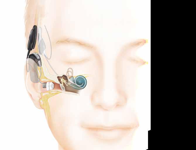 Das Implantat wandelt die digital codierten Audiosignale um in elektrische Impulse und leitet sie an den 3 Elektrodenträger in der Hörschnecke (Cochlea) weiter.