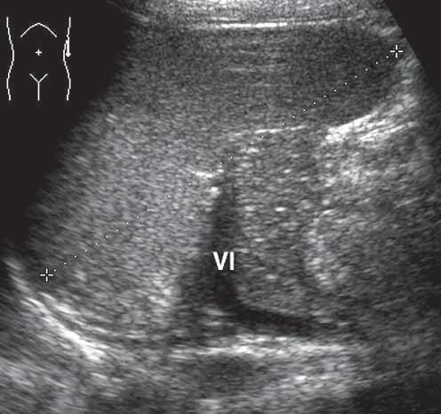 3 Pankreas Abdomensonographie Abb. 3: Normale Anatomie, Flankenschnitt links. Pankreasschwanz durch die Milz (mit Messstrecke markiert) hindurch langstreckig entlang der Vena lienalis (Vl) erkennbar.